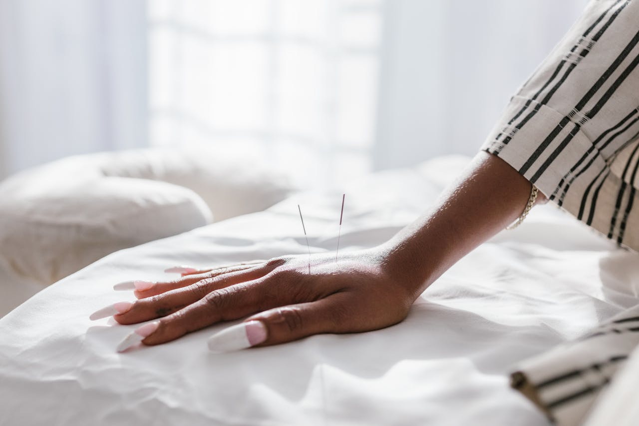 Close-up of a hand receiving acupuncture for holistic wellness in a spa setting.