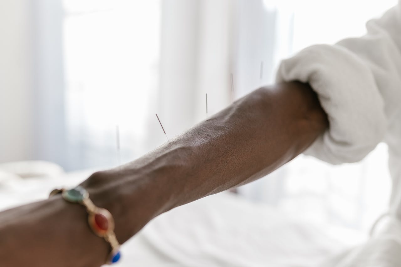 Close-up of acupuncture needles on a person's arm, indicating holistic therapy.