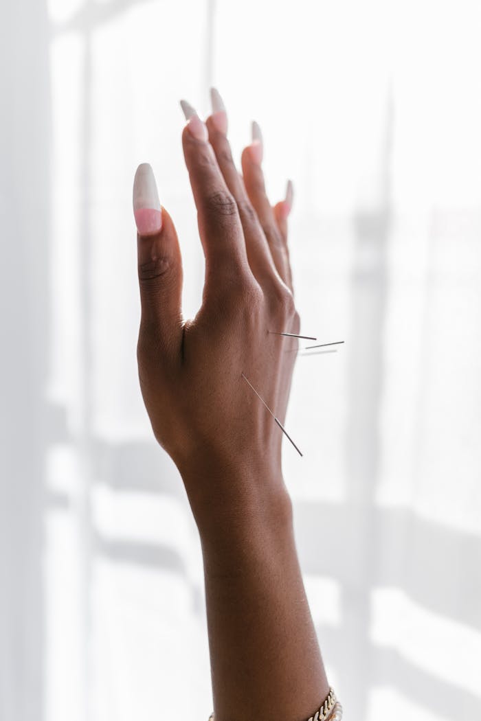Detailed image of acupuncture treatment with needles in hand on bright background.